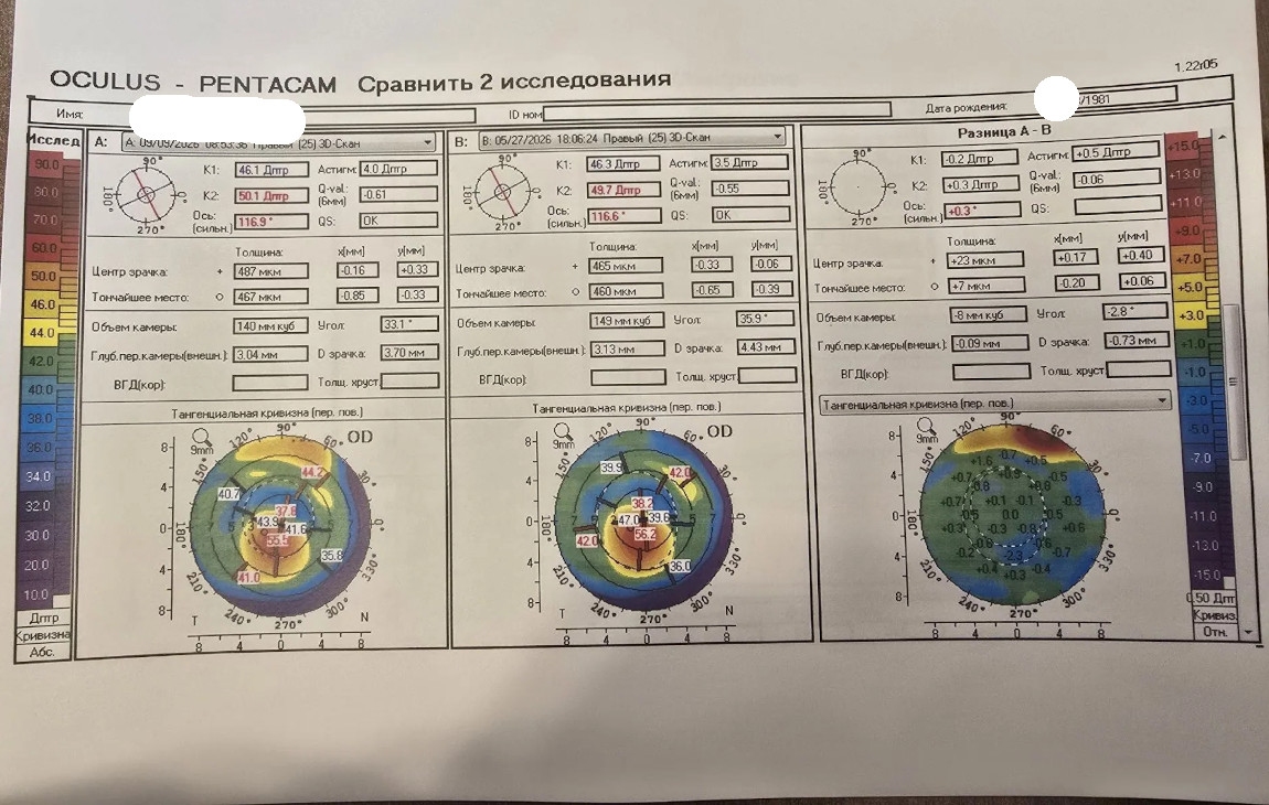 Лечение кератоконуса кросслинкингом или сочетанием лазерной коррекцией зрения