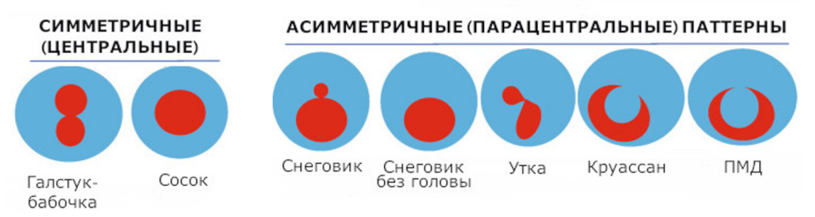 Различные формы (фенотипы) кератоконуса
