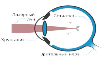 YAG-лазерный витреолизис